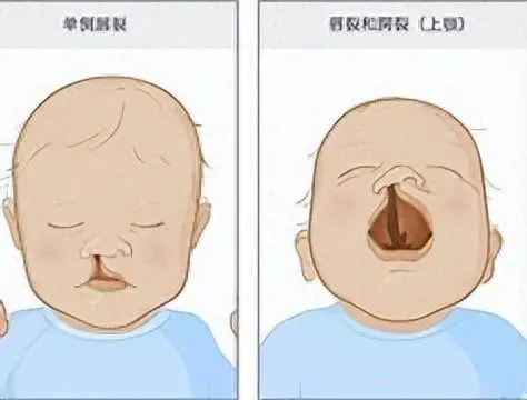 王菲女儿李嫣做第4次“兔唇”修复：照片公开大变样，美得很高级